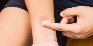 Piqure d-insecte qui enfle : que faire ?