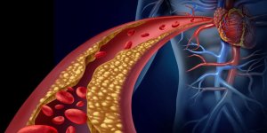 3 consequences du cholesterol sur la sante