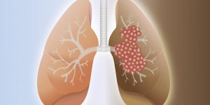 Recidive du cancer du poumon : les chances de survie