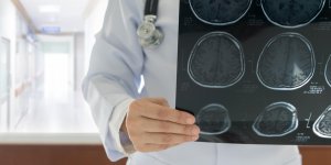 Mauvais bilan lipidique : attention au risque d-AVC