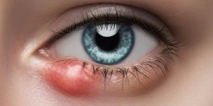 Cancer : son orgelet etait un carcinome epidermoide