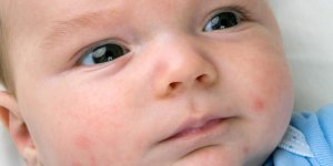 Acne du nourrisson : comment le reconnaitre ?
