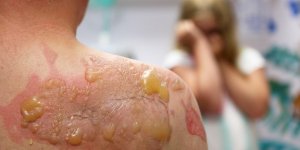 Cloque blanche sur une brulure : que faire ?