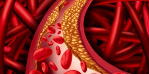 Troubles erectiles : l-atherosclerose en cause ?