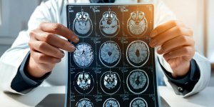 Un implant cerebral permet a une femme de retrouver la parole 18 ans apres un AVC