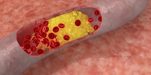 Le mauvais cholesterol favorise l-expansion d-un cancer