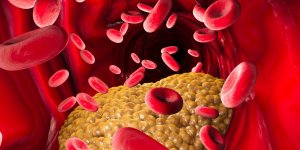 Triglycerides eleves : les aliments a eviter