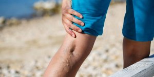 Plus on est grand, plus on risque d’avoir des varices aux jambes