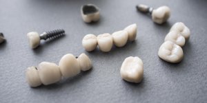 Prothese dentaire : la couronne ceramique et la couronne composite
