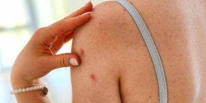 Allergie au chlore : les symptomes