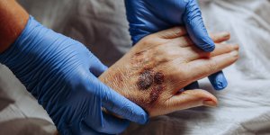 Arthrite : de faibles niveaux de testosterone pourraient l’accentuer