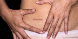 Appendicite : la prise d’antibiotiques, aussi efficace que l’operation ?