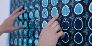 Tumeur au cerveau : l-heredite en cause ?