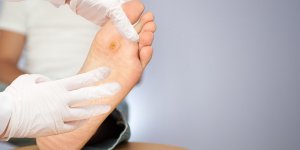 Verrue plantaire : comment savoir si elle est morte ?