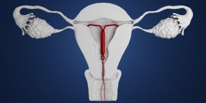 Contraception sans hormones : le sterilet au cuivre
