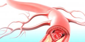 Atherosclerose : les principales consequences sur la sante