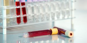Triglycerides eleves = trop de cholesterol aussi ?