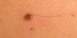Poils sur un grain de beaute : est-il dangereux de les arracher ?