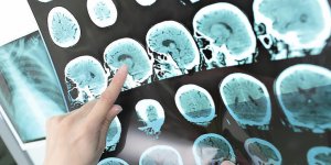 Cholesterol et AVC : comment sont-ils lies ?