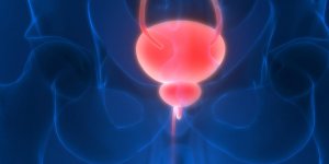 Quelles sont les causes des polypes a la vessie ?