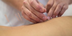 L-acupuncture pour arreter de fumer : le prix des seances