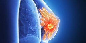 Cancer triple negatif : qu-est-ce que c-est ?
