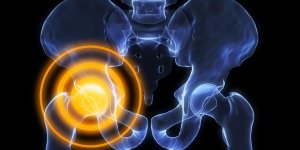 Coxarthrose destructrice rapide : la definition