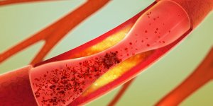 Cholesterol HDL, LDL, VLDL et IDL : qu-est-ce que c-est ?