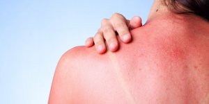 Coup de soleil : une femme devoile une effrayante cloque apres avoir bronze sans creme