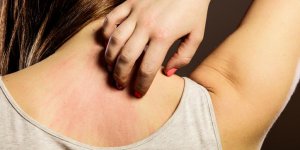 Piqure de puce : les traitements