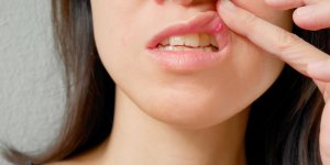 Aphtes : la menopause, une periode propice