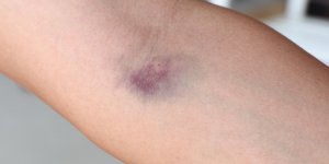 Ce bleu qui ne voulait pas partir etait en fait un cancer rare de la peau