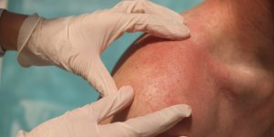 Coup de soleil : nos astuces pour ne pas peler