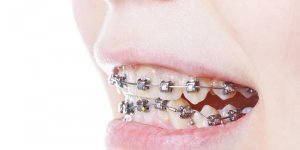 Appareil dentaire : que faire quand les gencives sont gonflees ?