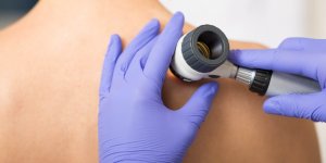 Cancer de la peau : quels sont les signes d’alerte ? 