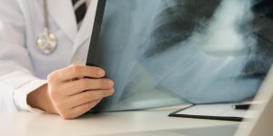 Densitometrie osseuse : comment se faire rembourser ? 