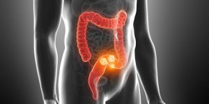 Cancer du colon : un taux de mortalite plus eleve pour les patients touches du cote droit