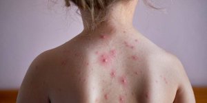 Varicelle ou rougeole : comment faire la difference ?