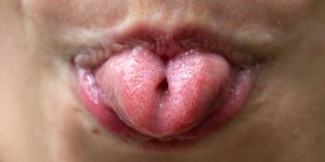 Langue : ce que sa couleur revele de votre sante