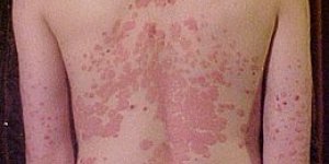 Reconnaitre le psoriasis du dos et des fesses