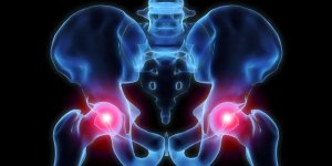 Arthrose de hanche: les changements avec une prothese