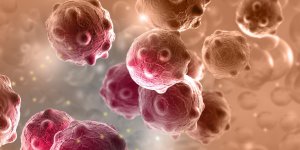 Cancer de la peau : qu-est-ce qu-un carcinome spinocellulaire ?