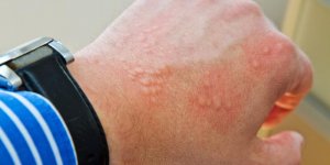 Eruption cutanee : un signe d-urticaire