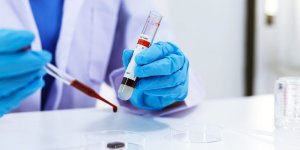 Demence : trop de bon cholesterol accroit les risques