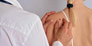 Cancer de la peau : depistage, facteurs de risque et traitements