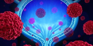 Cancer de la vessie : un risque d-infertilite chez la femme