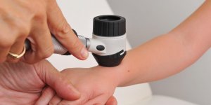 Cancer de la peau : qu-est-ce que le melanome achromique ?