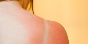 Comment soigner un coup de soleil avec cloques en urgence ?