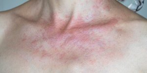 Lucite, urticaires… Quelles sont les causes des allergies au soleil ? 