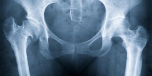 Contraception : le sterilet a la progesterone